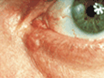 Basal Cell Carcinoma — Mackay, QLD — Smart Scan Clinic