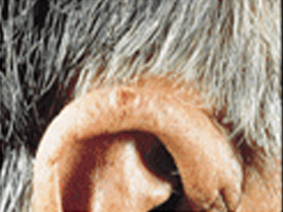 Squamous Cell Carcinoma — Mackay, QLD — Smart Scan Clinic