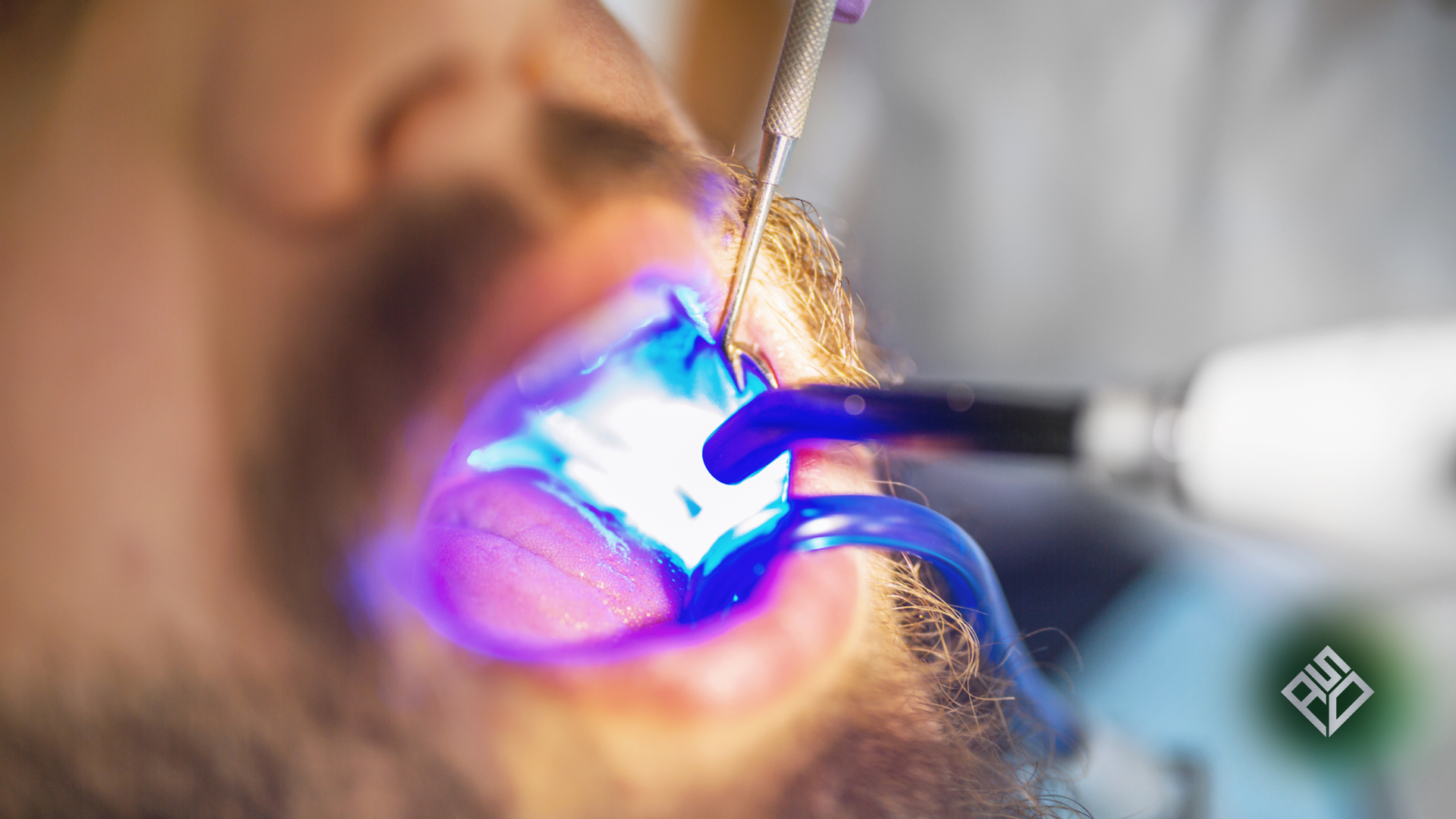 Dentist using a blue light to harden dental filling in patient's open mouth.