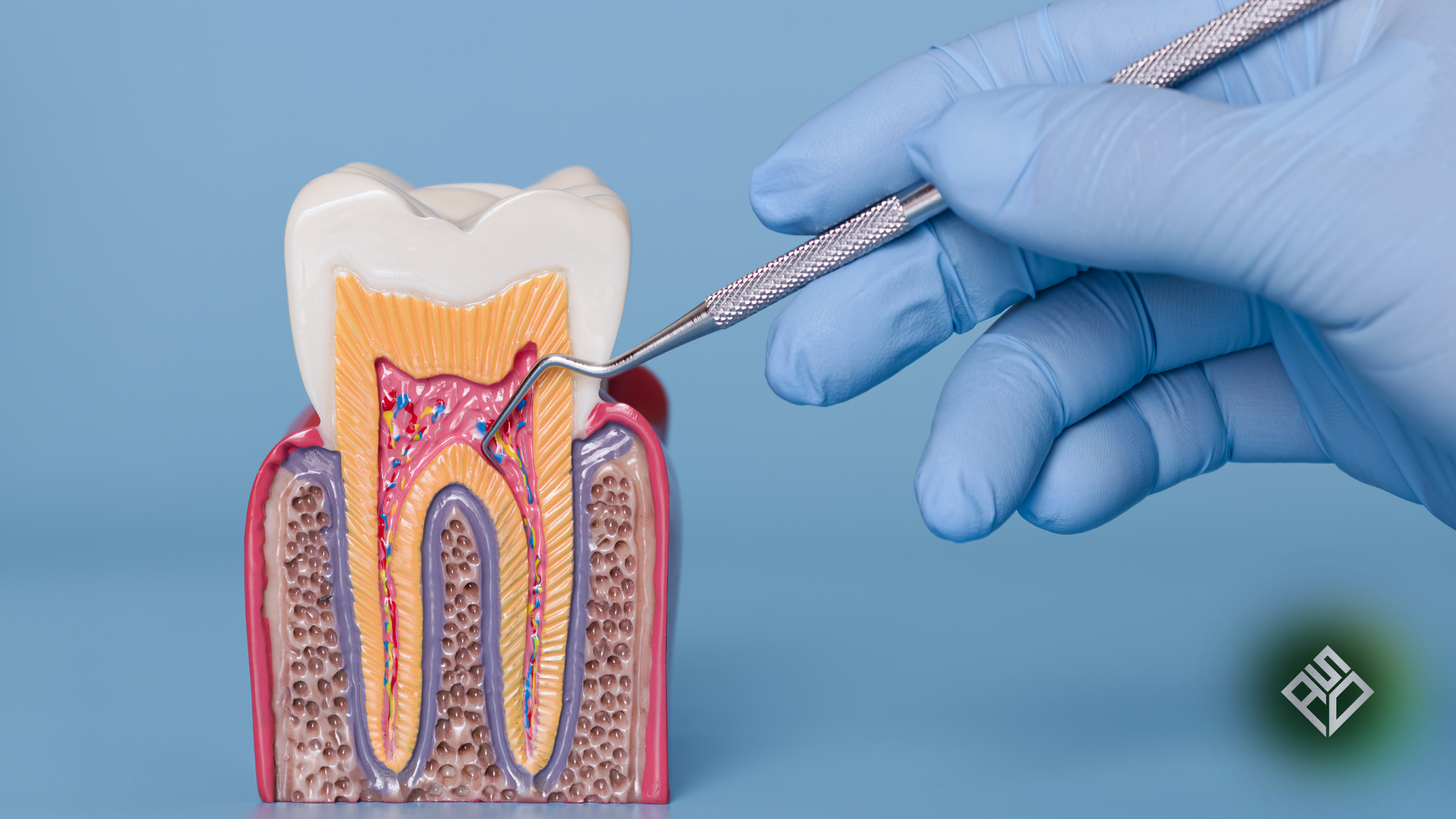 Hand in blue glove holding dental tool examining tooth model.