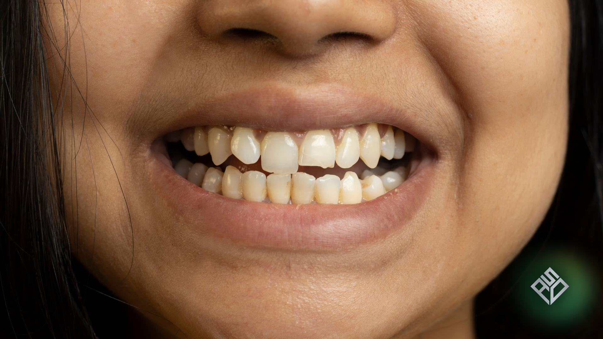 Close-up of teeth in a smile. Slightly yellowed teeth are visible, with a small gap in the front.