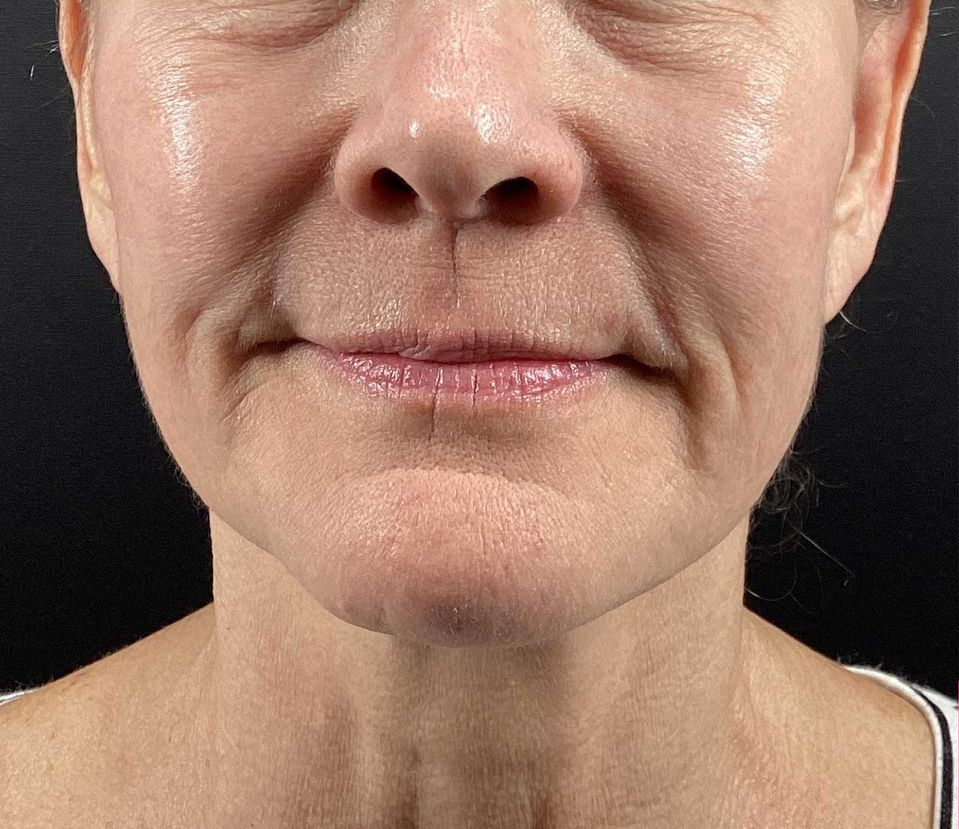 Close-up of a person's face showing skin texture, wrinkles around the mouth, and slight smile.