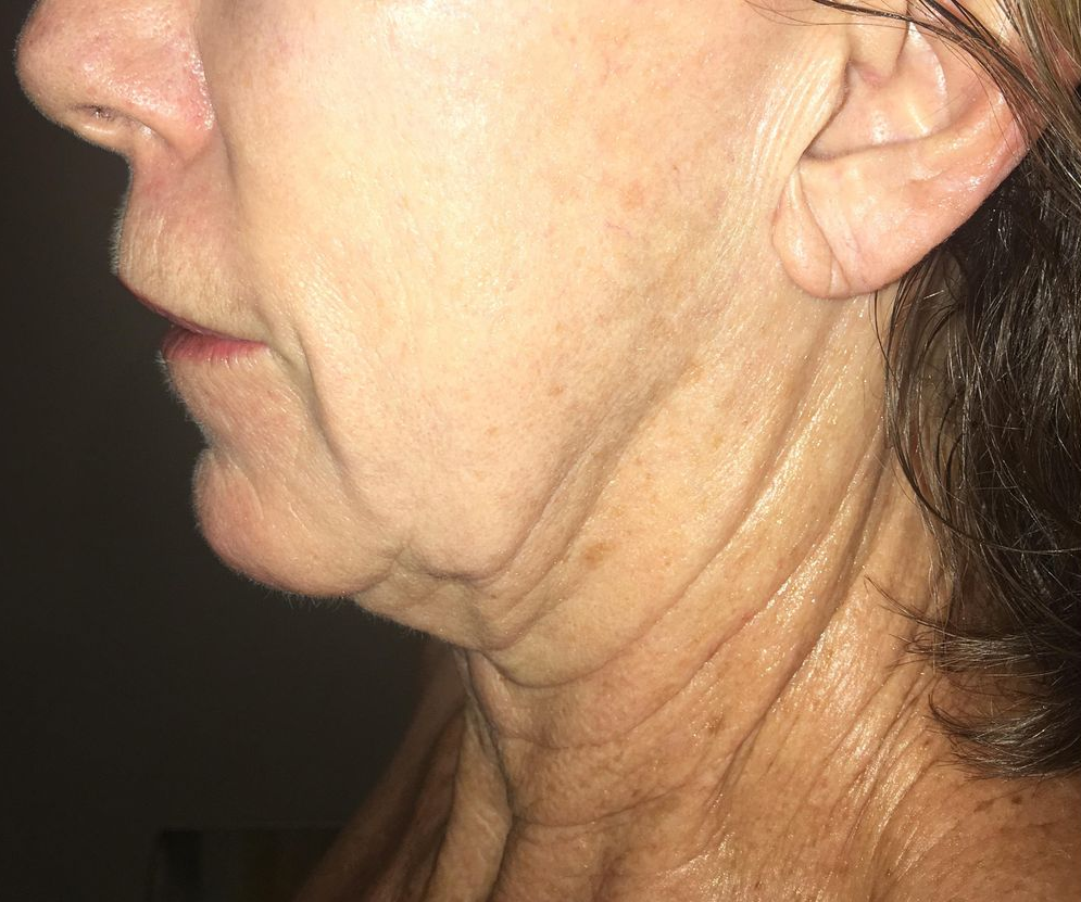 Profile view of a person's neck and chin, showing wrinkles and sagging skin.