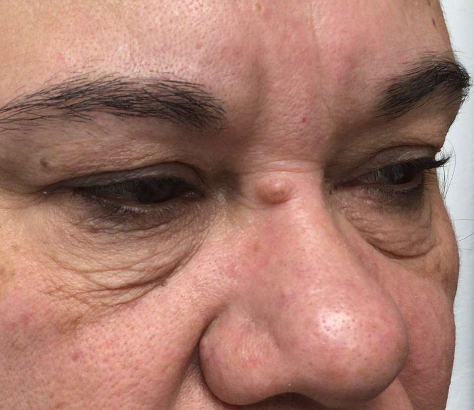 Close-up of a person's face showing a raised, light-colored bump on the bridge of their nose.