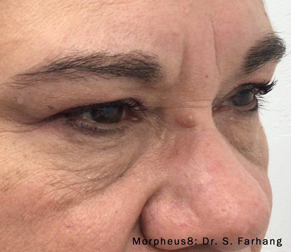 Close-up of a person's face showing a raised, light-colored growth on the nose between the eyes, wrinkles are present.