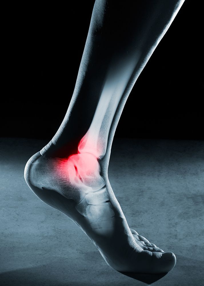 Total Ankle Replacement