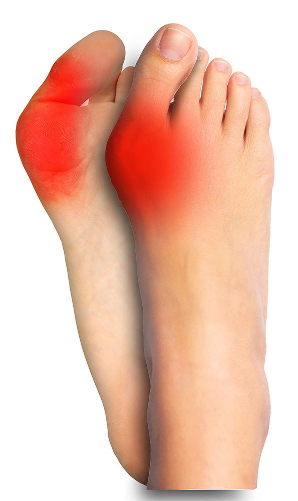 Bunions