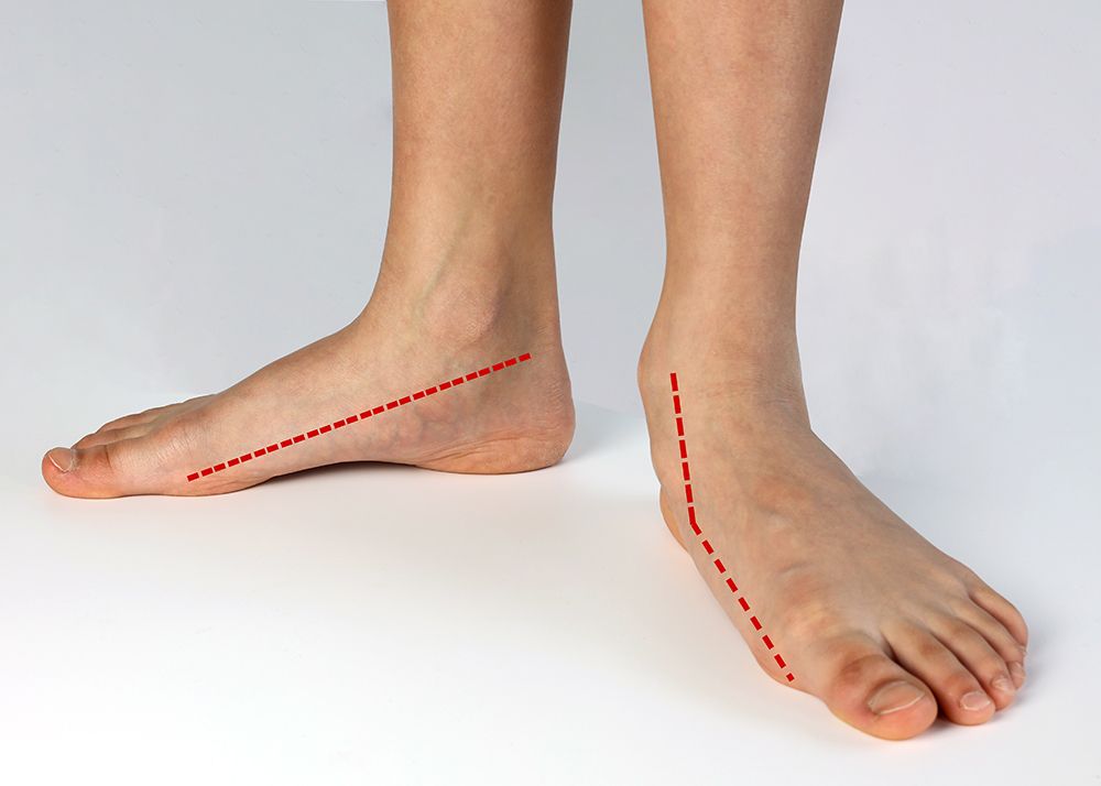 Medial Arch Reconstruction