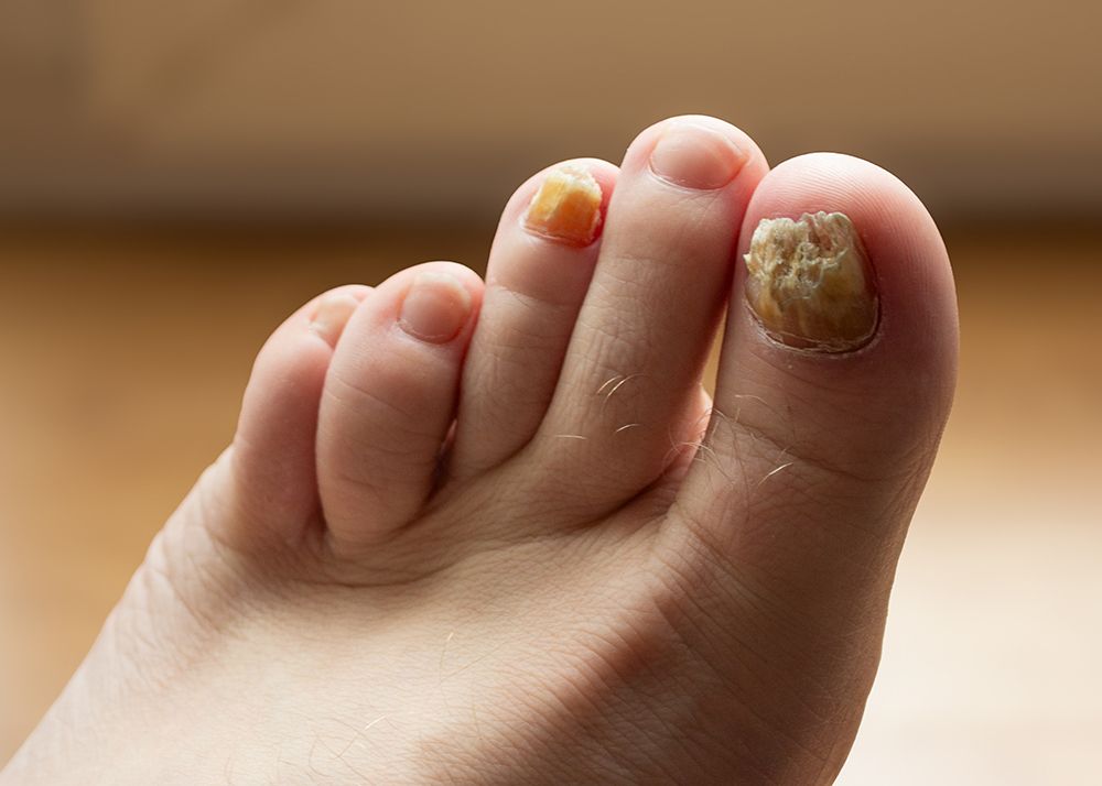 Fungal Toenails