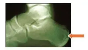 Foot X-Ray