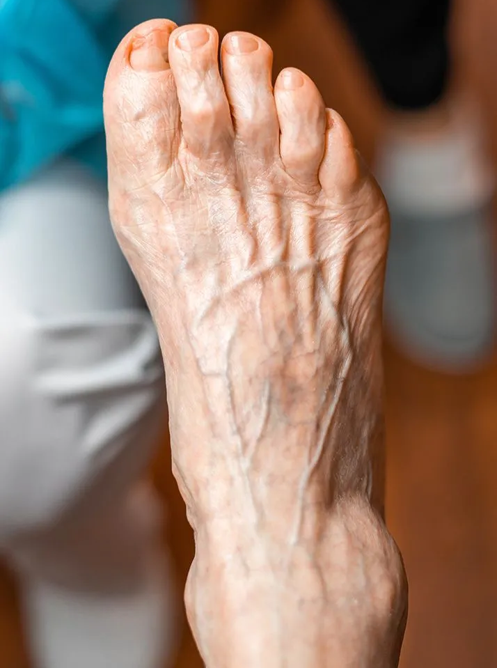 Diabetic Foot Care