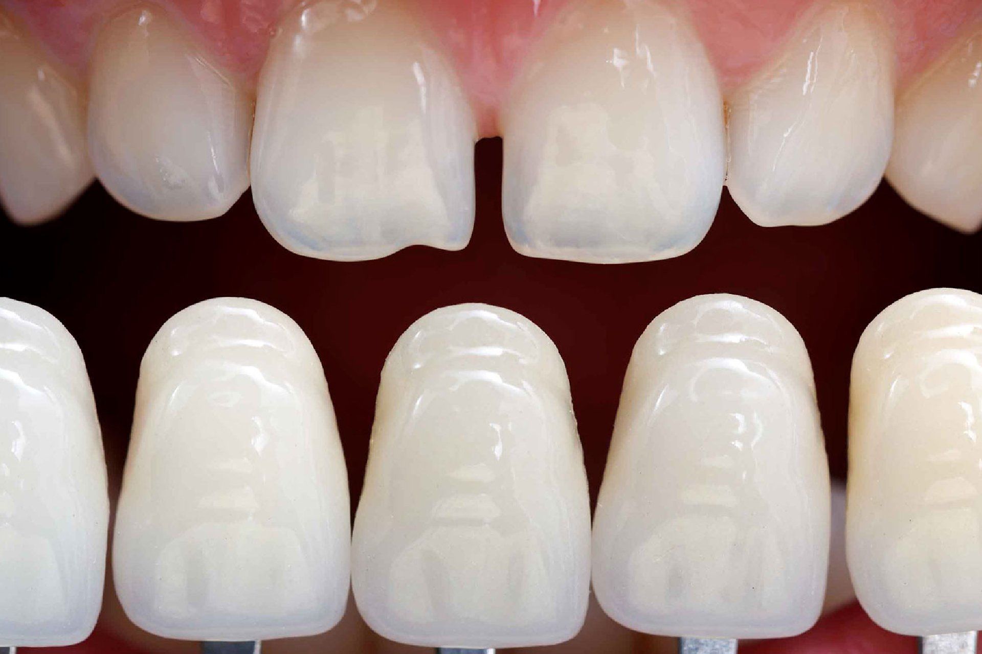 posizionamento faccette dentali