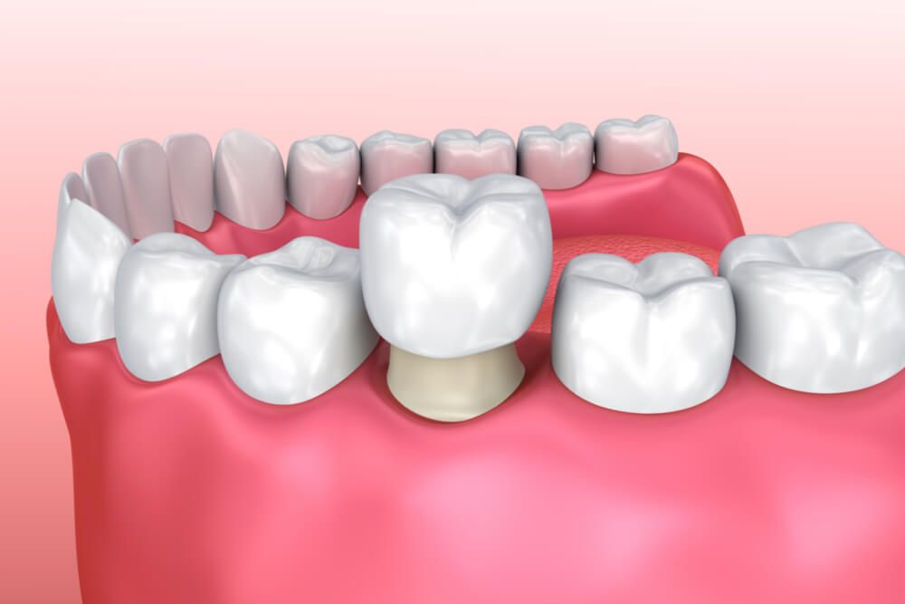 denti dopo inserimento corona
