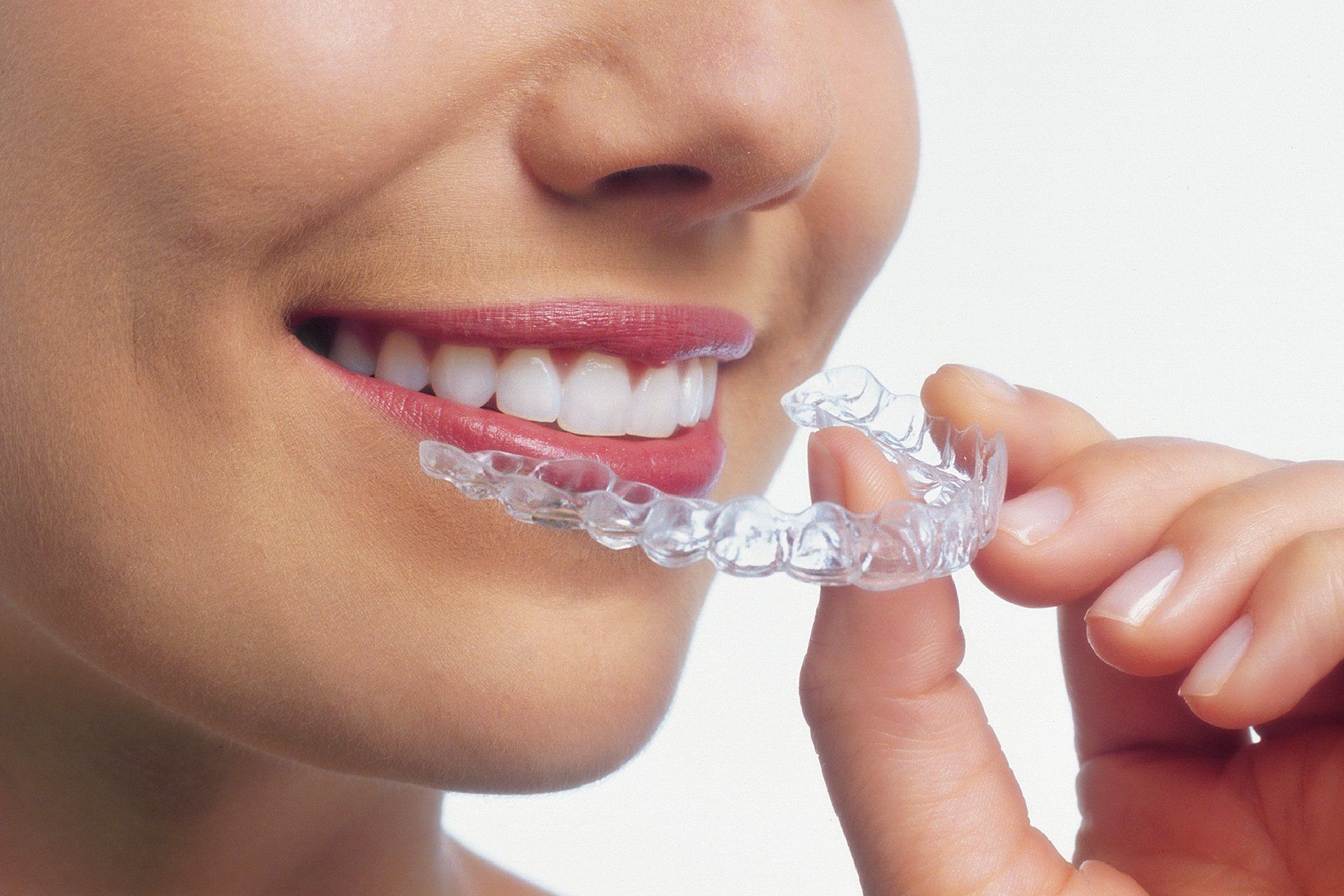 apparecchio invisalign
