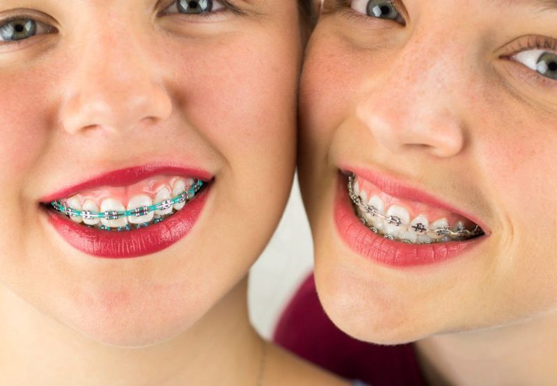 apparecchi dentali fissi