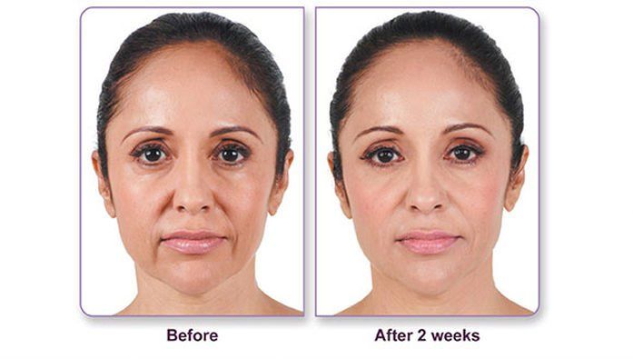A before and after photo of a woman 's face.