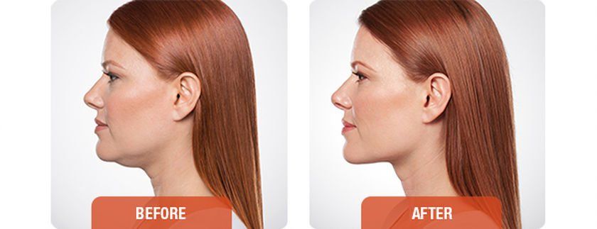 A before and after photo of a woman 's face with red hair.