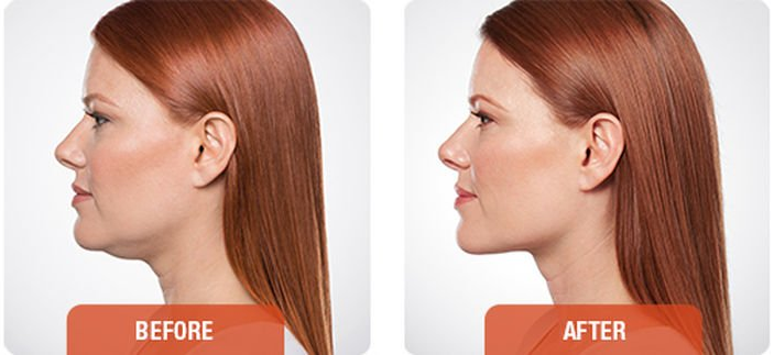 A before and after photo of a woman with red hair.