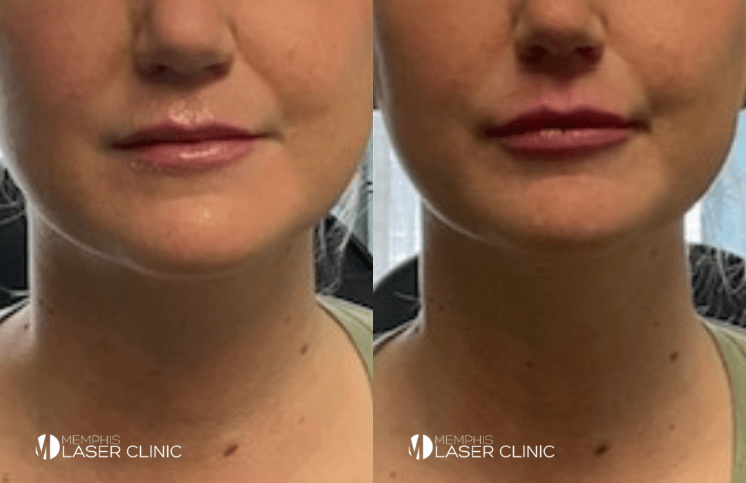 Lip Fillers Info Memphis Laser Clinic Cordova TN