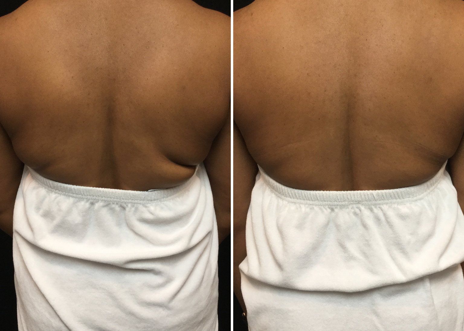 A before and after picture of a woman 's back