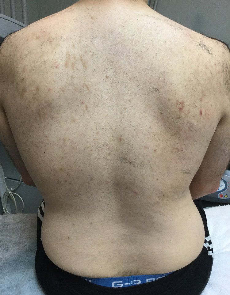A man 's back with a lot of spots on it.