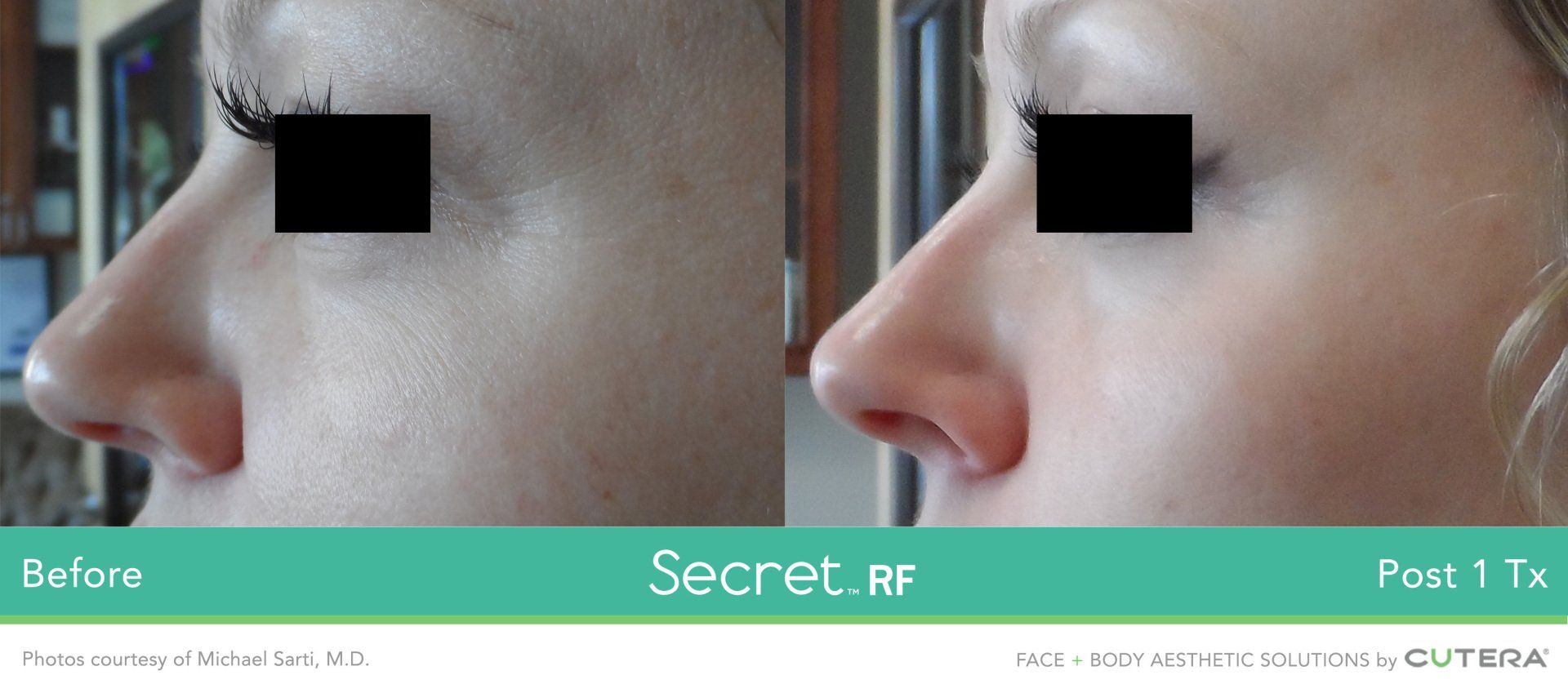 A before and after photo of a woman 's nose