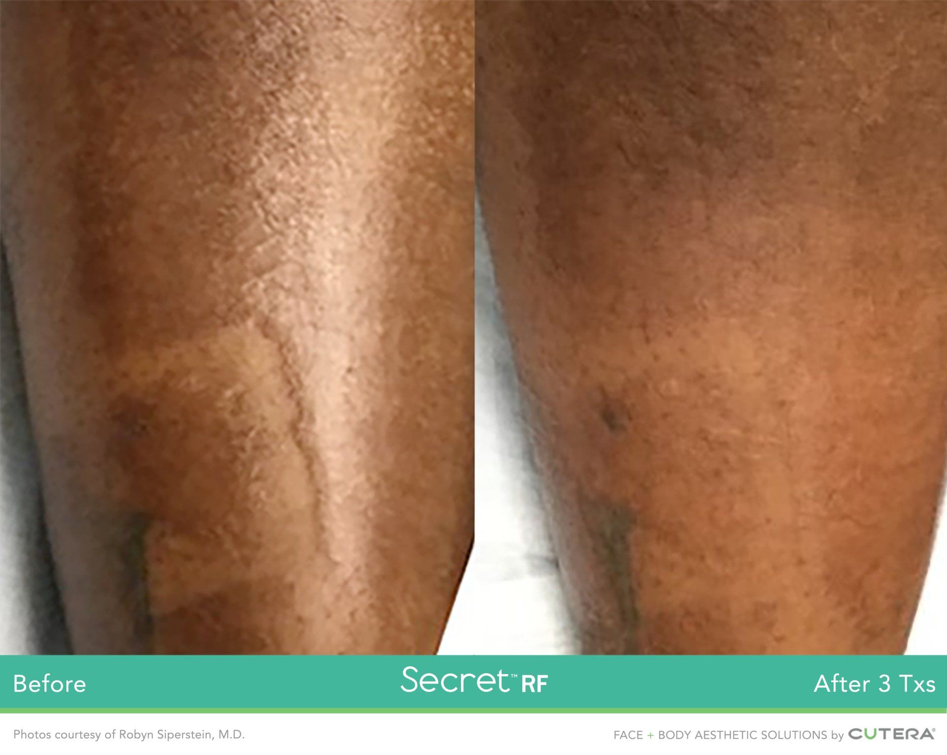 A before and after photo of a person 's leg