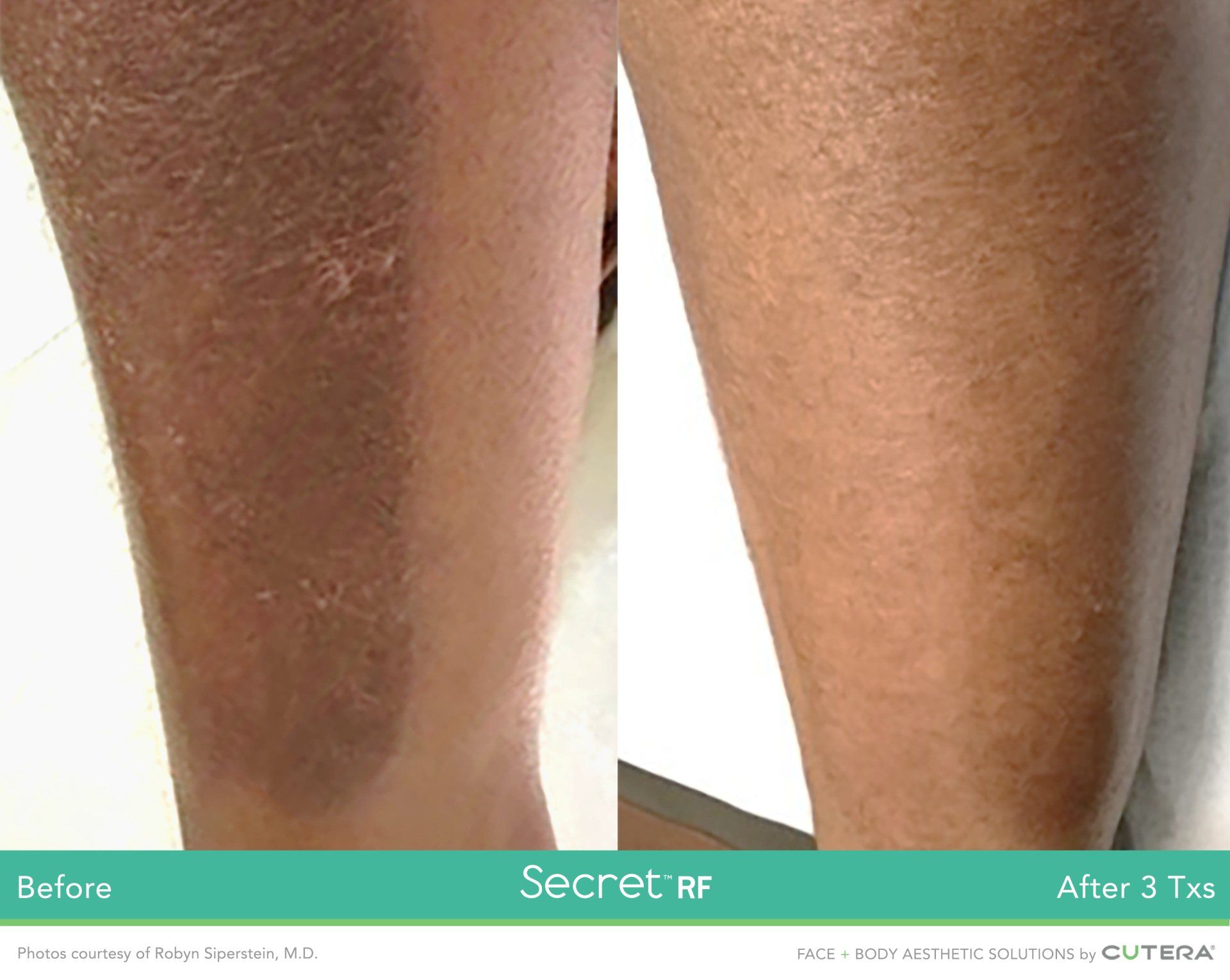 A before and after photo of a person 's leg.