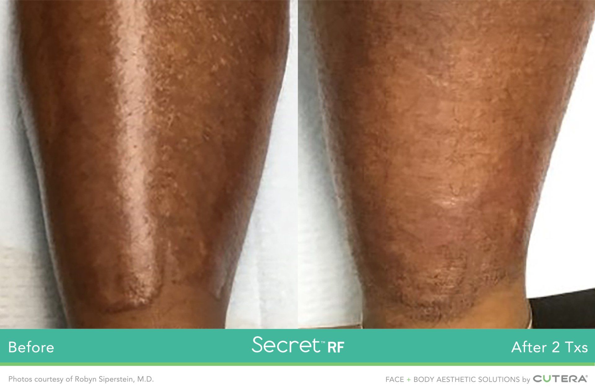 A before and after photo of a person 's legs.