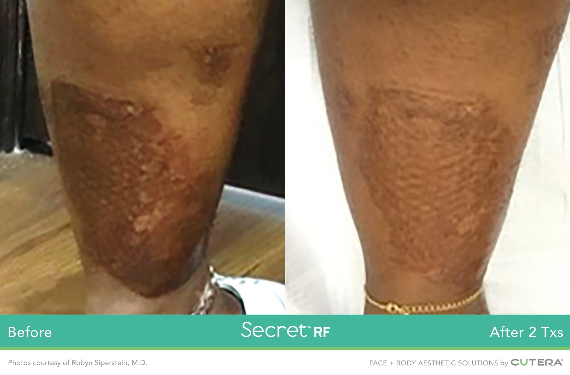 A before and after photo of a person 's leg.