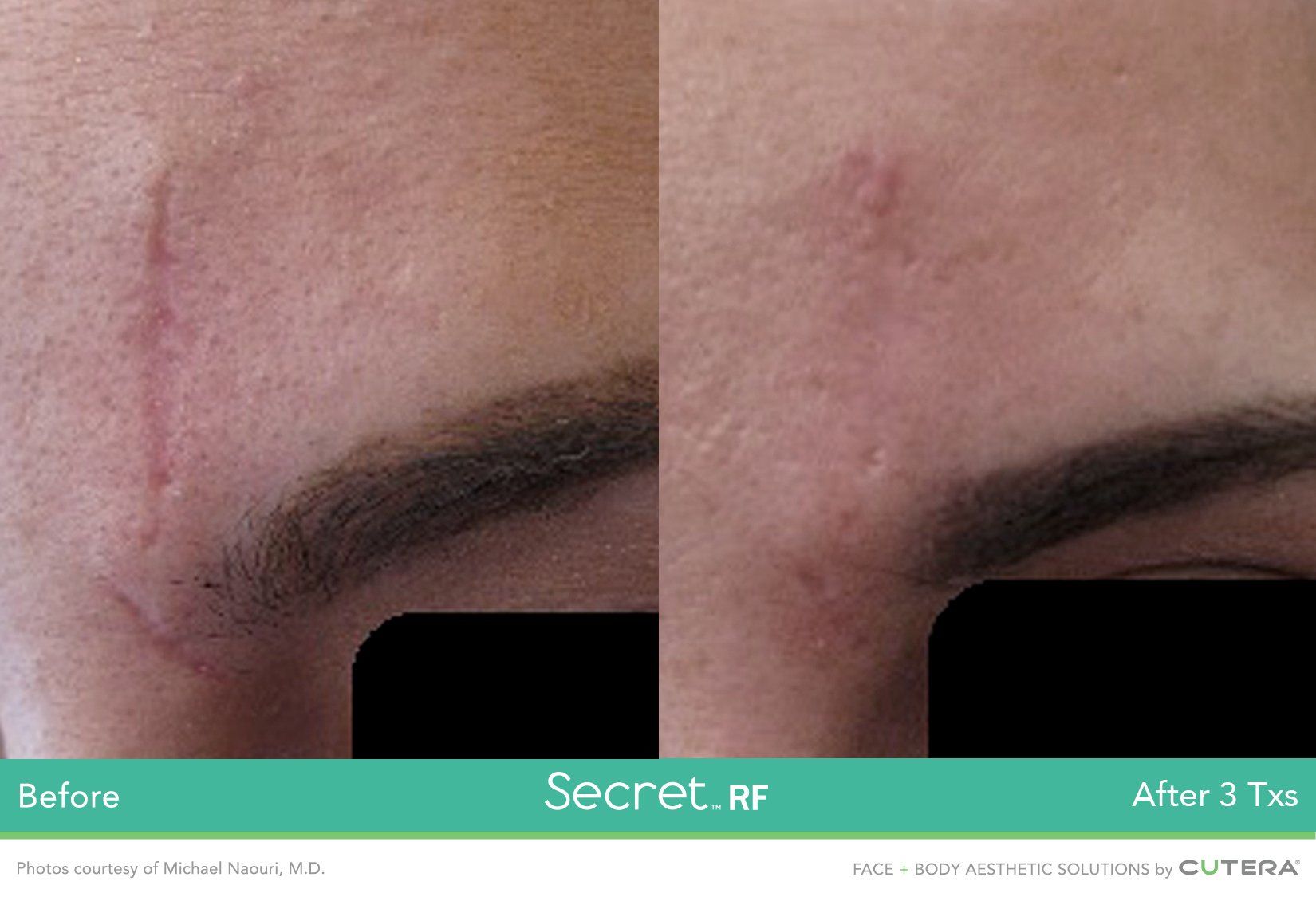 A before and after photo of a woman 's forehead with a scar.