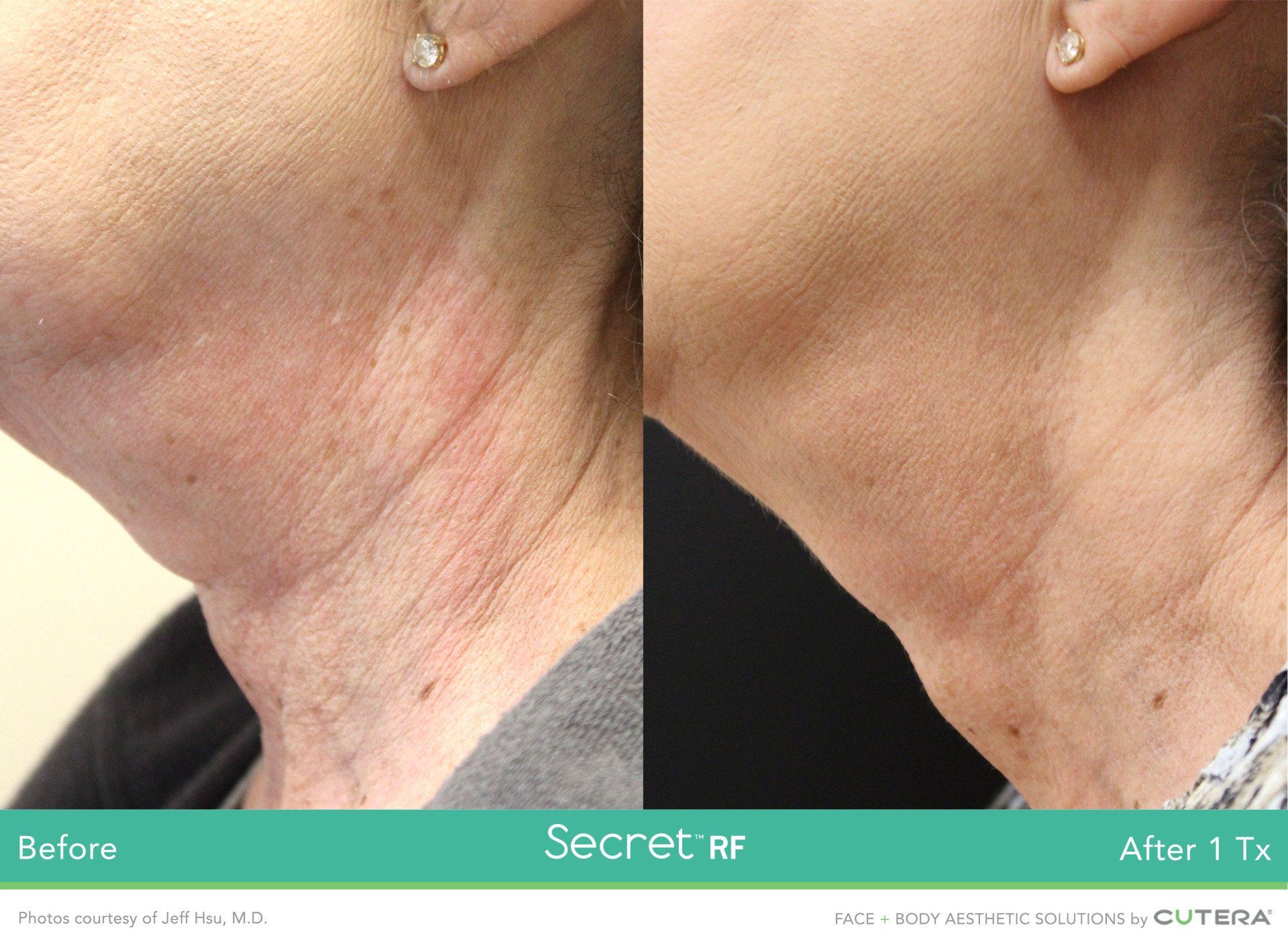 A before and after photo of a woman 's neck and neckline.