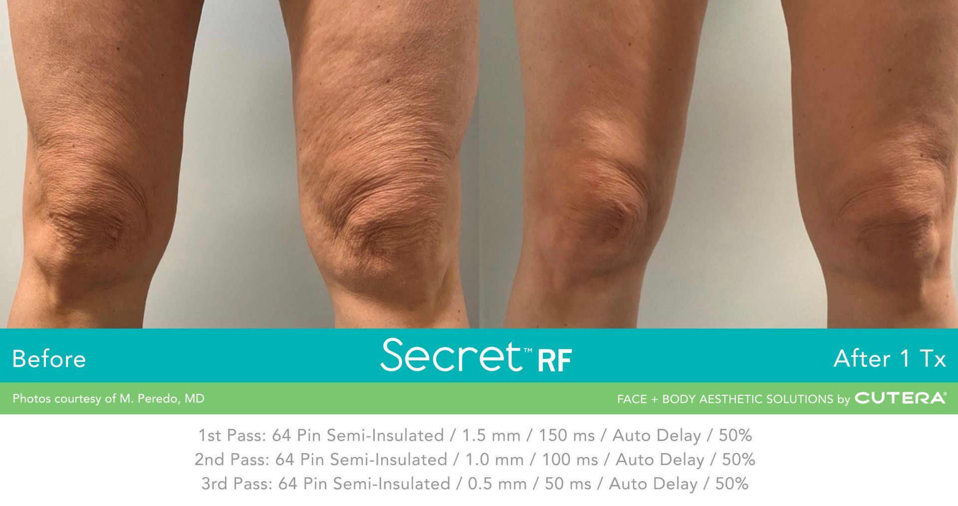 A before and after photo of a person 's knee.