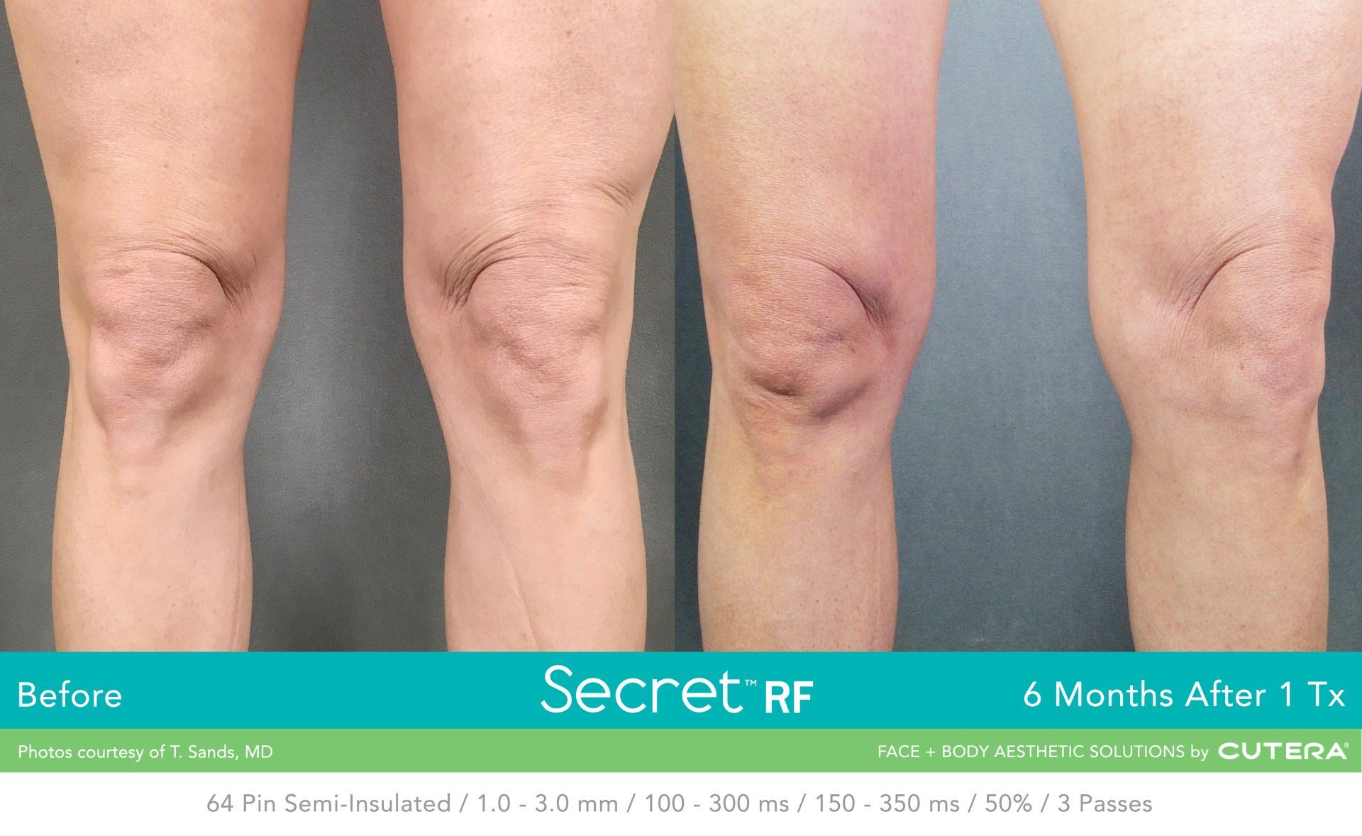 A before and after photo of a person 's knee with secret rf written on the bottom