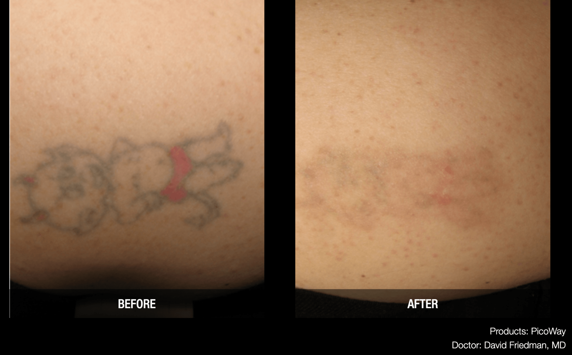 Advanced Tattoo Removal Memphis Laser Clinic