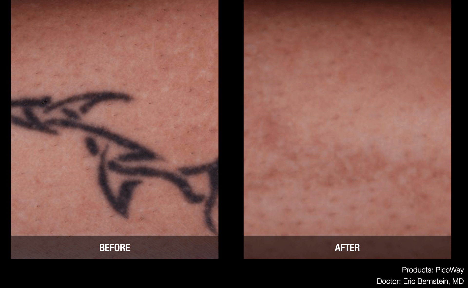 Advanced Tattoo Removal | Memphis Laser Clinic