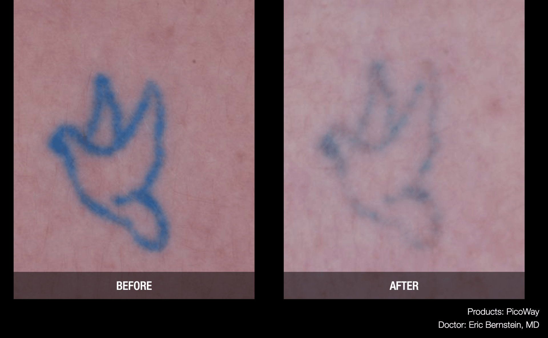 Advanced Tattoo Removal Memphis Laser Clinic