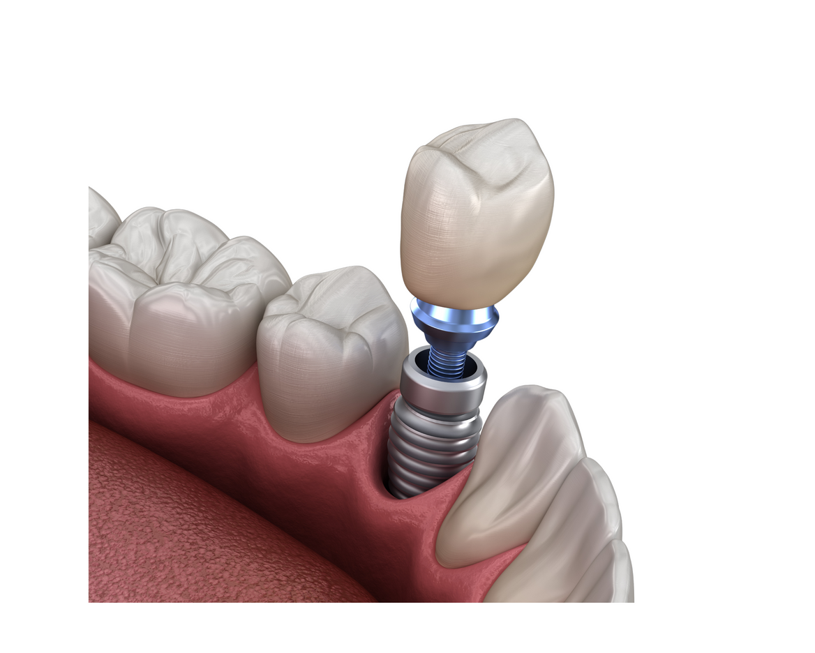 a close up of a tooth with a dental implant in it