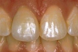 a close up of a person 's teeth with white spots on them .