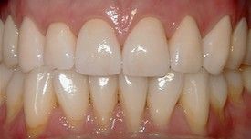 a close up of a person 's teeth with white teeth .