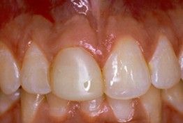 a close up of a person 's teeth and gums .
