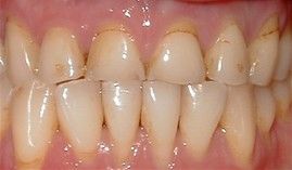 a close up of a person 's teeth with a lot of stains on them .