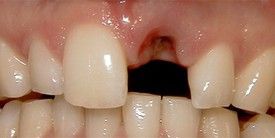 a close up of a person 's teeth with a missing tooth .