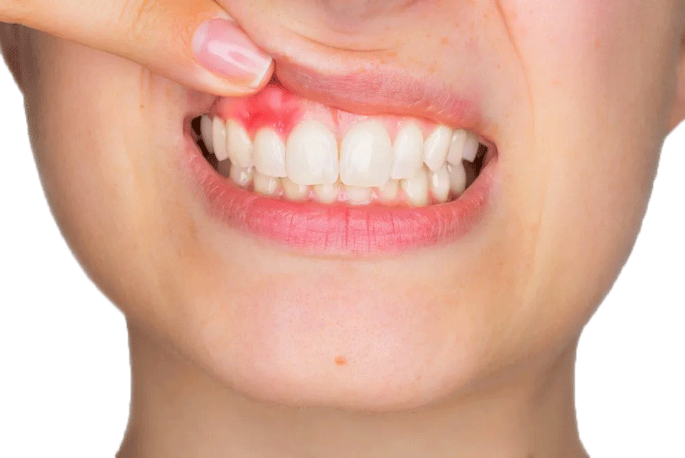 gingivectomy image