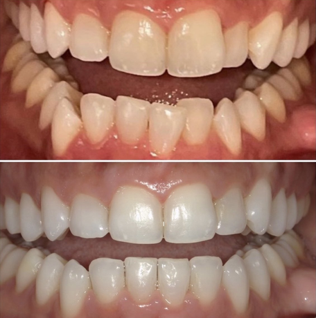 before and after 3 midtown dental care nyc