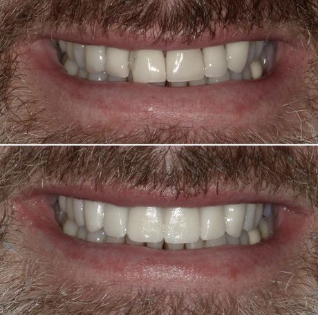 before and after 1 midtown dental care nyc