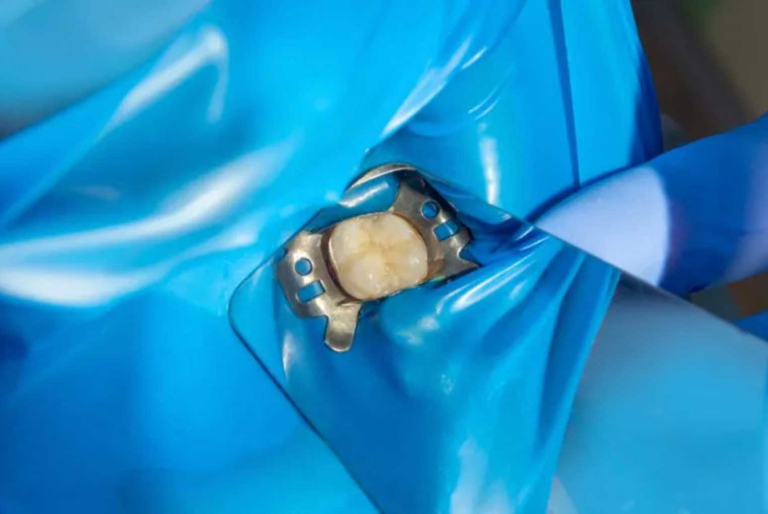 dental fillings image