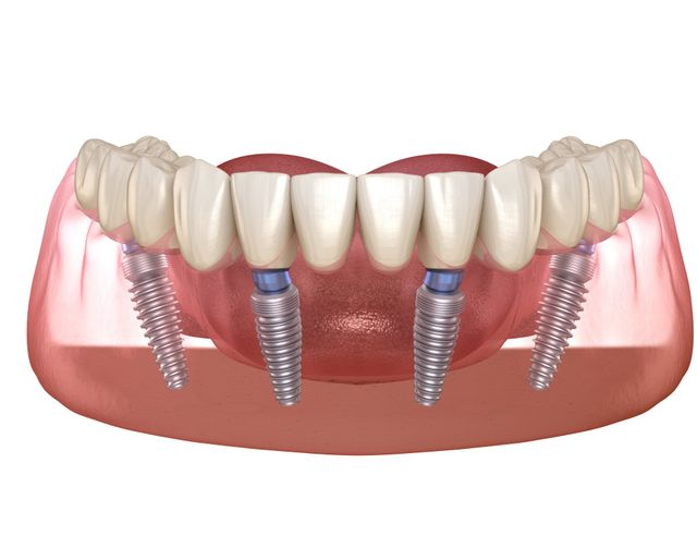 All On 4® Dental Implants Midtown Manhattan - Midtown Dental Care NYC