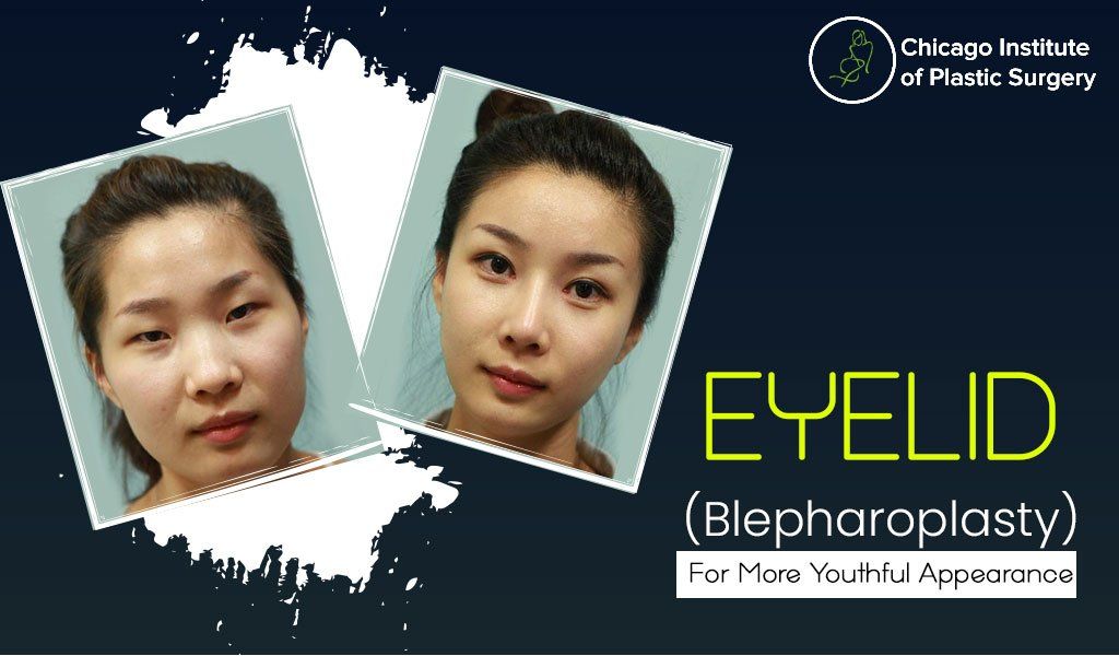 Eyelid-Blepharoplasty Treatment in Chicago – For More Youthful Appearance