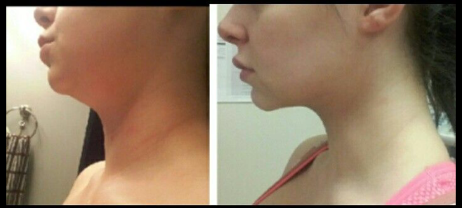 A before and after photo of a woman 's neck and face
